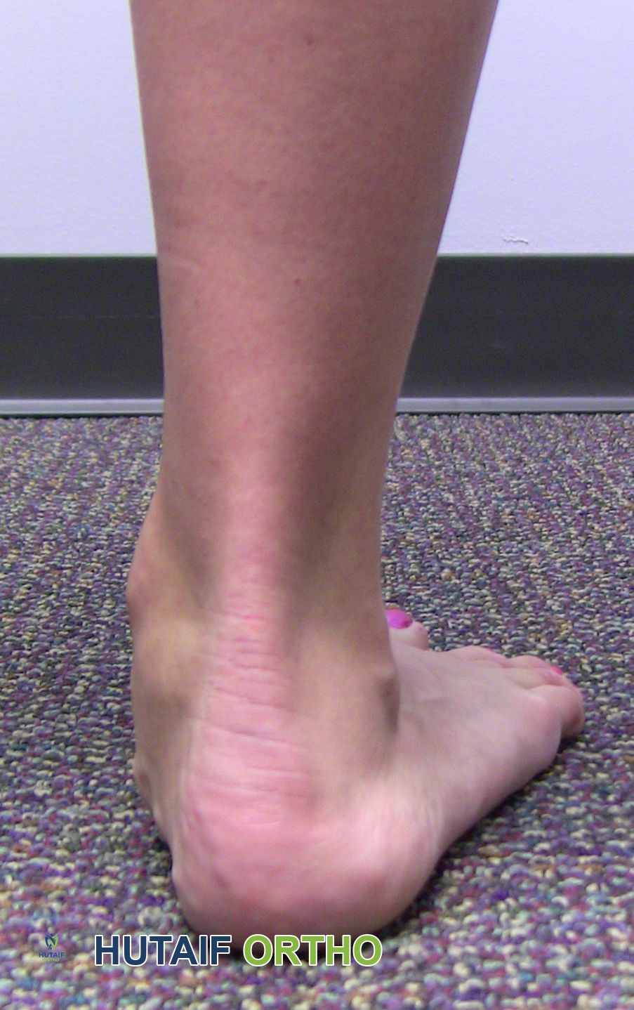 Photo of flat feet